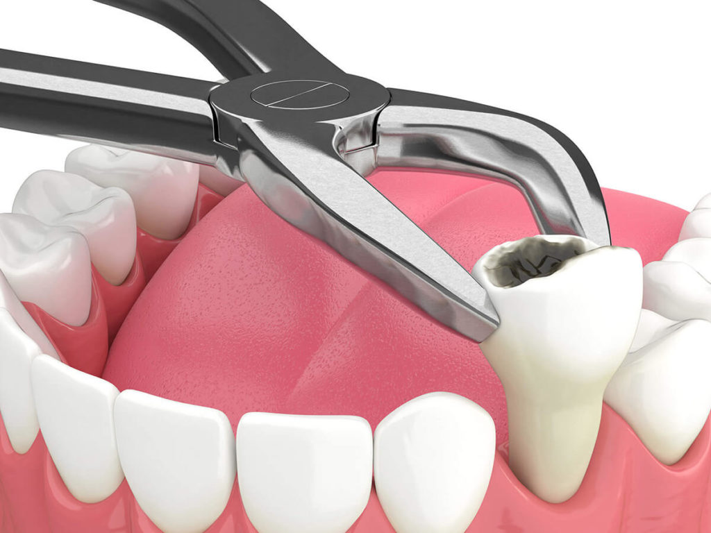 Teeth Removal