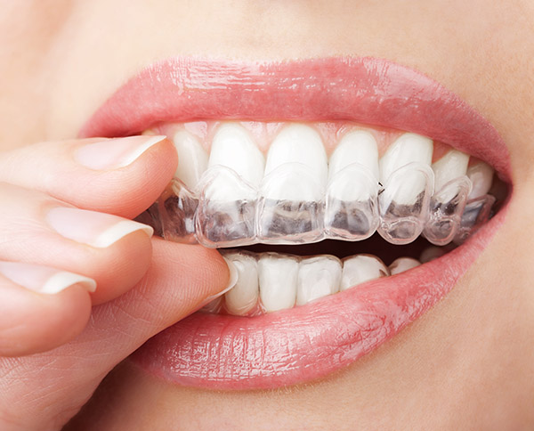 Teeth Straightening 